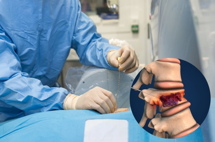 Vertebroplasty & Kyphoplasty-----33